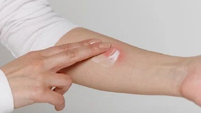 Apakah Aman Mengoleskan Odol pada Luka Bakar? Ini Penjelasan Lengkapnya