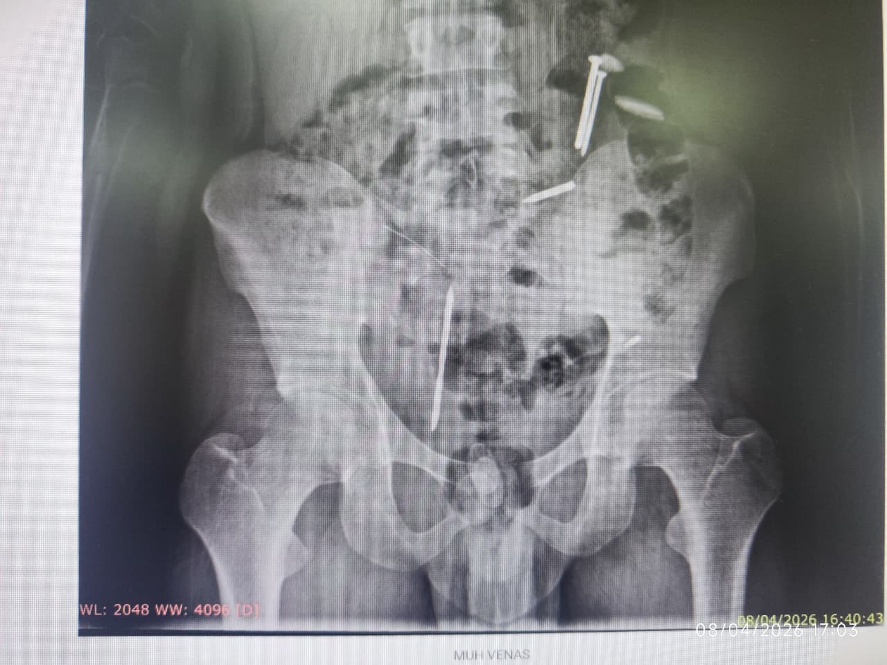 Ngeri! Ada Paku dan Logam Bersarang di Perut Korban Pemasungan di Puger Jember
