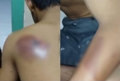 Santri Gresik Diduga Jadi Korban Perundungan Sesama Santri, Punggung Luka Bakar, Keluarga Pilih Damai