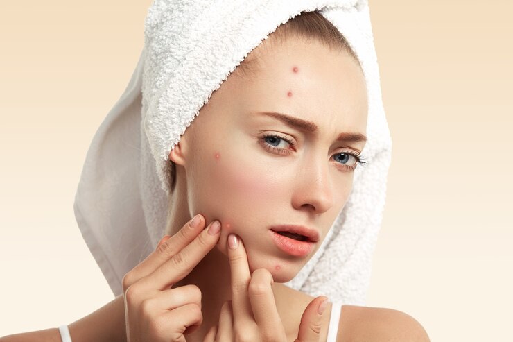 Tren Kecantikan: Amankah Menggunakan Acne Patch Setiap Hari?