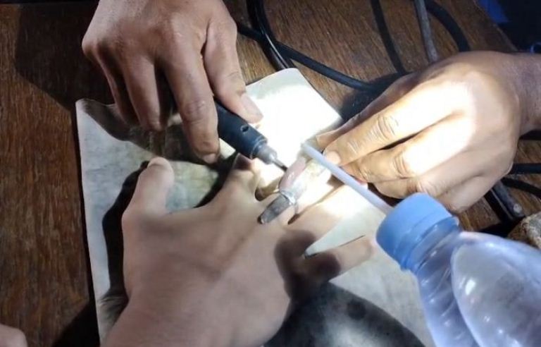 Cincin Tak Bisa Dilepas hingga Jari Bengkak, Remaja Gresik Dievakuasi Damkar