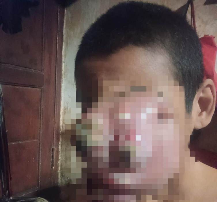 Wanita Pacar Keling Derita Kanker Hidung, Wajah Bengkak Akibat Komplikasi Pasca-Operasi
