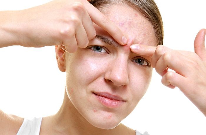 Jerawat di Area T-Zone Bisa Picu Infeksi Otak hingga Risiko Fatal