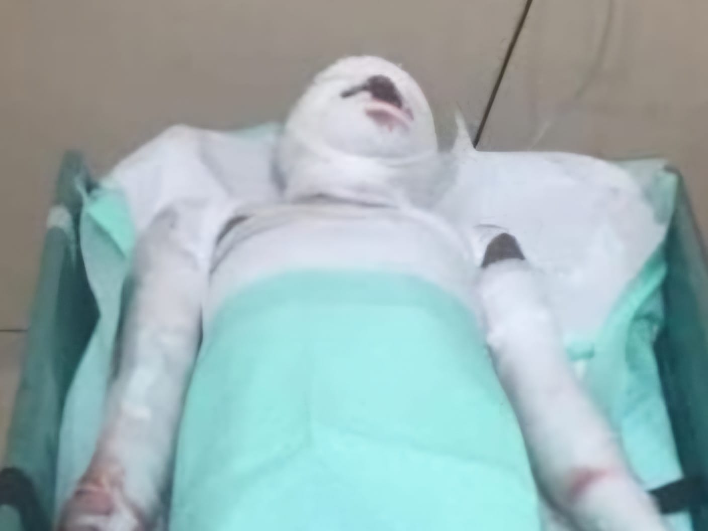 Korban Ledakan Bondet Pasuruan Akhirnya Meninggal Dunia