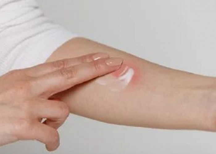 Apakah Aman Mengoleskan Odol pada Luka Bakar? Ini Penjelasannya Lengkapnya