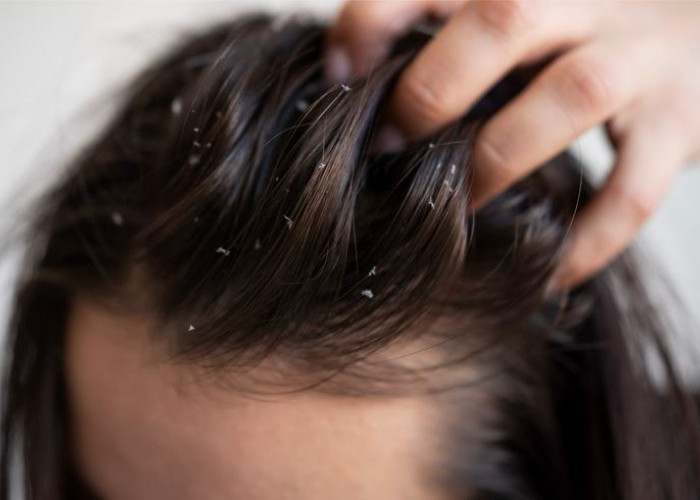 Cara Ampuh Mengatasi Kutu Rambut dengan Cara Alami dan Obat Kimia yang Aman