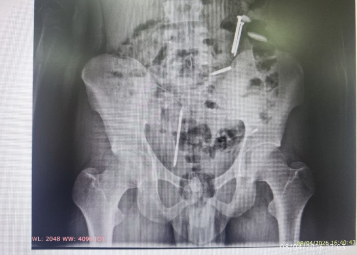 Ngeri! Ada Paku dan Logam Bersarang di Perut Korban Pemasungan di Puger Jember