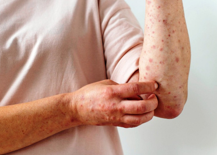 Kemenkes RI Catat 73 Kabupaten Alami KLB Campak, Kenali Gejala dan Pencegahannya