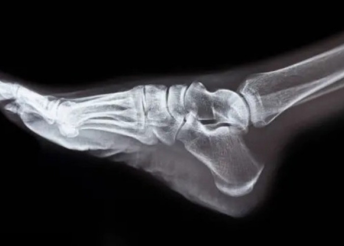 Hari Kanker Tulang Nasional 11 April, Ini Cara Meningkatkan Kesadaran dan Edukasi Masyarakat