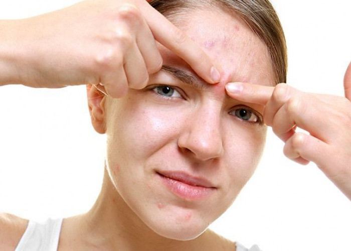 Jerawat di Area T-Zone Bisa Picu Infeksi Otak hingga Risiko Fatal