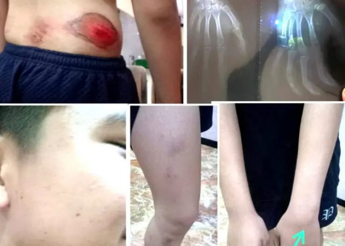 Diduga Dianiaya Oknum Tim Respatti Polrestabes Surabaya, Remaja Bronggalan Lapor Propam Polda Jatim