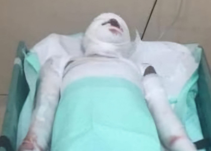 Korban Ledakan Bondet Pasuruan Akhirnya Meninggal Dunia