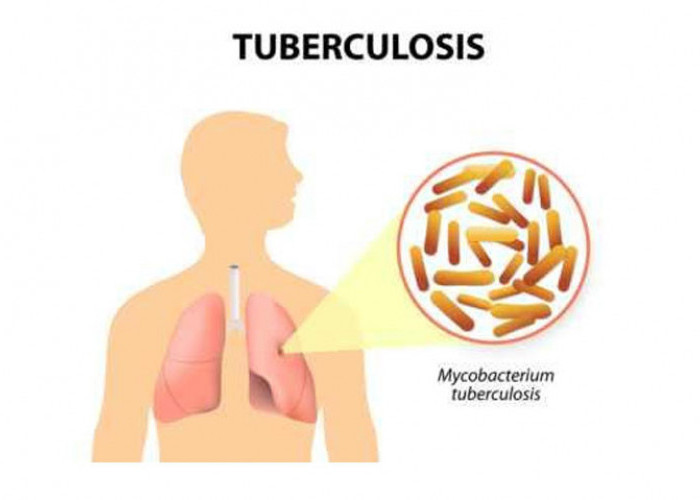 Temuan Kasus TBC Capai 809 Ribu pada 2023, Kemenkes Bongkar Penyebab Meningkatnya karena Ini