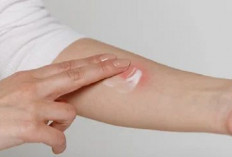 Apakah Aman Mengoleskan Odol pada Luka Bakar? Ini Penjelasannya Lengkapnya