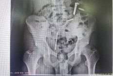 Ngeri! Ada Paku dan Logam Bersarang di Perut Korban Pemasungan di Puger Jember