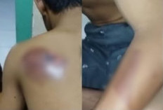 Santri Gresik Diduga Jadi Korban Perundungan Sesama Santri, Punggung Luka Bakar, Keluarga Pilih Damai