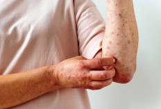 Kemenkes RI Catat 73 Kabupaten Alami KLB Campak, Kenali Gejala dan Pencegahannya