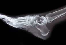 Hari Kanker Tulang Nasional 11 April, Ini Cara Meningkatkan Kesadaran dan Edukasi Masyarakat