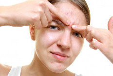 Jerawat di Area T-Zone Bisa Picu Infeksi Otak hingga Risiko Fatal